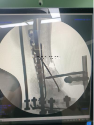 【最新病例】三臂十一軸機器人輔助器牽引——骨折外固定術骨折案例分享